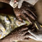 Au total, 42'000 cas de mpox ont été enregistrés en Afrique depuis janvier et quelque 1100 personnes sont mortes (archives). KEYSTONE/EPA/MICHAEL LUNANGA